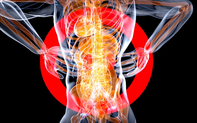 Sciatica